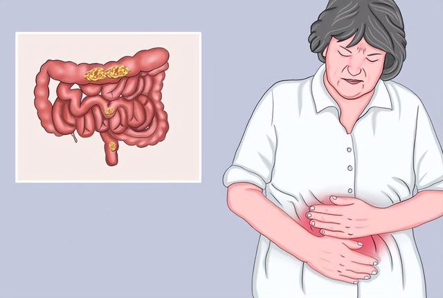 慢性非萎缩性胃炎是什么意思伴糜烂（慢性非萎缩性胃炎是什么意思严重吗,要多久才能治好）